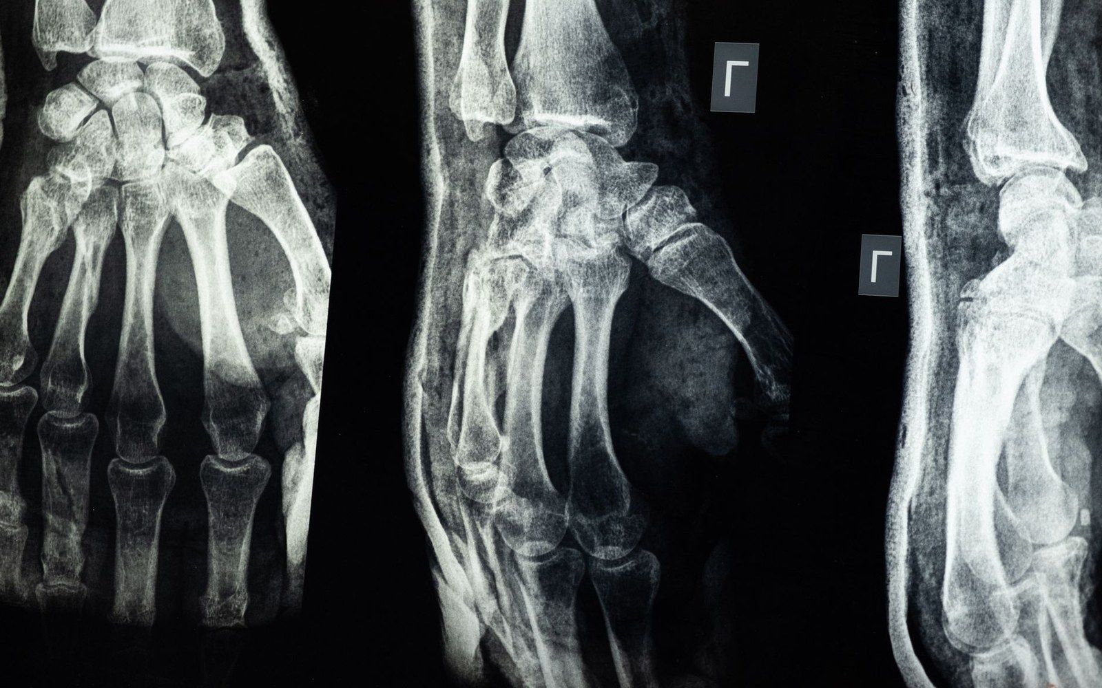 X-rays of a hand and wrist showing bones of the fingers, palm and carpal joints