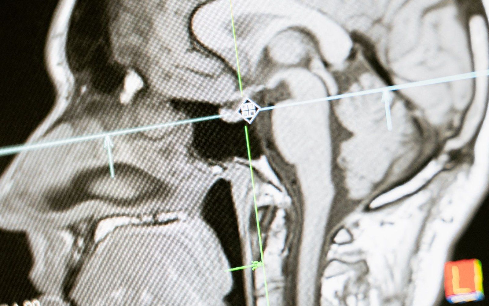 An MRI console with a sagittal brain scan displayed on the monitor, operator's hands visible on the keyboard